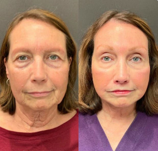 Rejuvenecedor - Palp Lifting Invisible